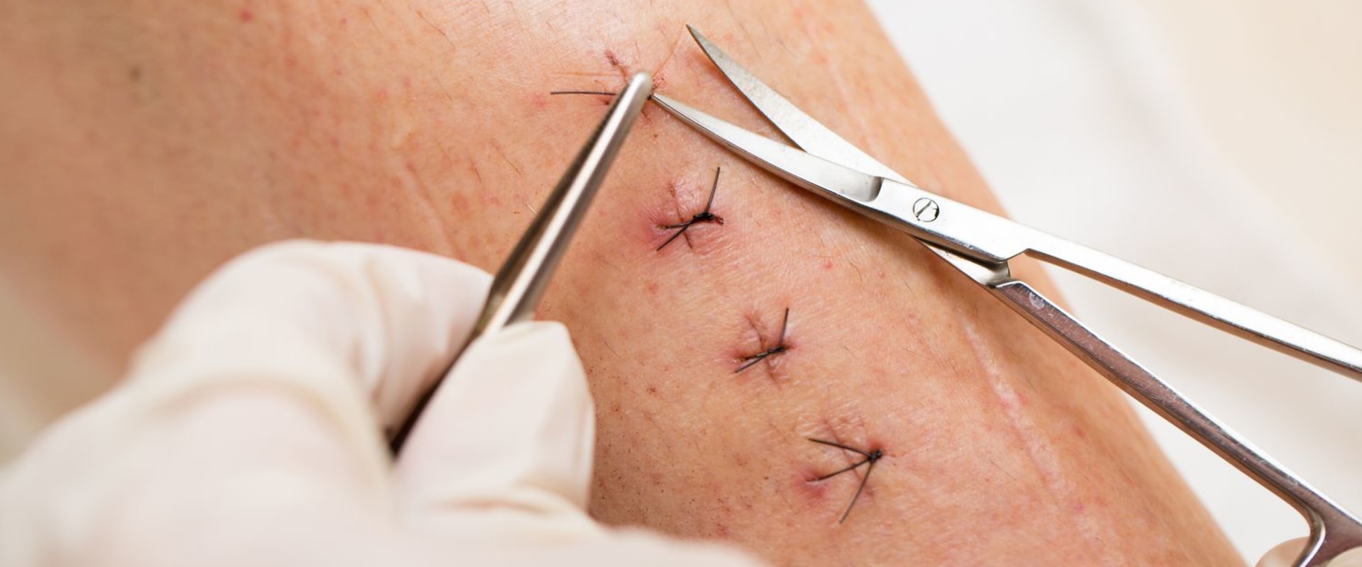 What Do Dissolvable Stitches Look Like vs Regular Ones?