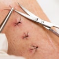 What Do Dissolvable Stitches Look Like vs Regular Ones?