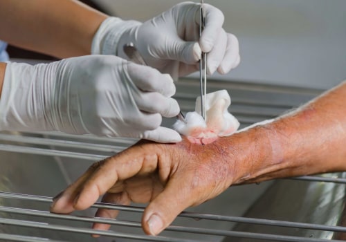 How Enzymatic Debridement Works: Is It the Future of Wound Care?