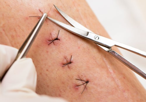 What Do Dissolvable Stitches Look Like vs Regular Ones?