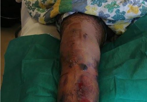 The Revolutionary Treatment of Negative Pressure Wound Therapy: A Comprehensive Guide